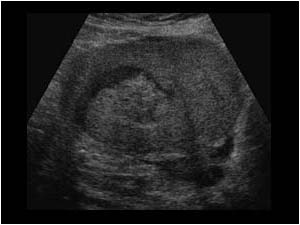Polypoid mass and fluid filled endometrial canal