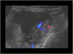 Vascularized thick walled partly cystic mass