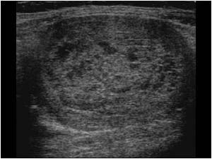Recidivation of an endometrial carcinoma