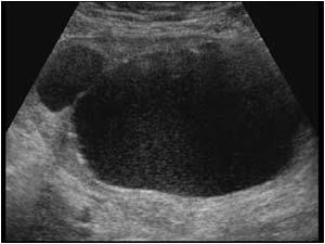 Large benign ovarian cyst