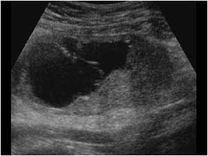 Large benign ovarian cyst