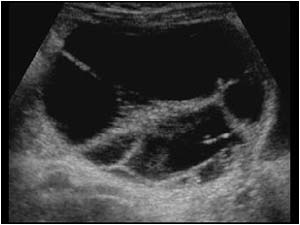 Large septated benign ovarian cyst