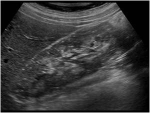 Longitudinal image of the right kidney