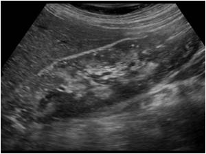 Another longitudinal image of the right kidney