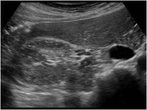 Transverse image of the right kidney