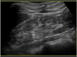 Another longitudinal image of the left kidney