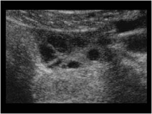 Normal left ovary