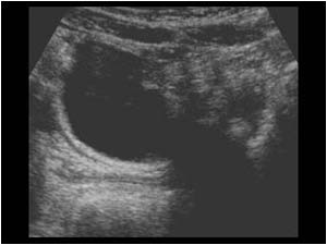 Cystic mass containing structures with acoustic shadowing