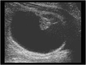 Cystic mass containing intracystic structures