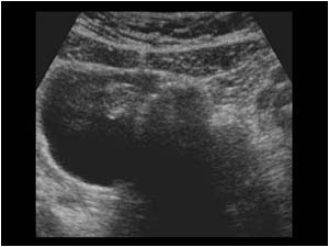 Cystic mass containing structures with acoustic shadowing