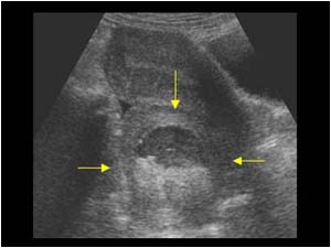 Cystic mass with echogenic structures posterior to the uterus longitudinal