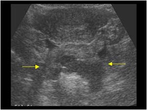 Cystic mass with echogenic structures posterior to the uterus transverse