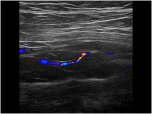 Longitudinal image of the popliteal artery showing a severe stenosis with a very narrow and irregular lumen