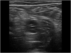 transverse image of the popliteal artery showing cystic changes in the wall of the artery
