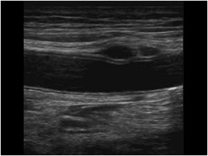 Longitudinal image of the common femoral artery showing the cystic changes