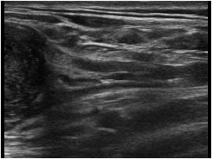 Longitudinal image showing that the massis in continuity with a nerve