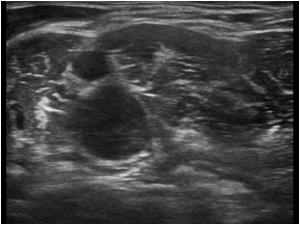 Transverse image a bit below the mass shows normal findings