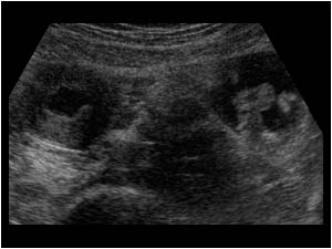 Uterus and free peritoneal fluid in the left lower abdomen