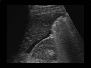 Free peritoneal fluid in Morrison pouch