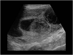 Cystic mass with solid structures