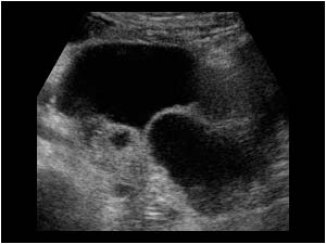 Irregular partly cystic mass posterior to the bladder