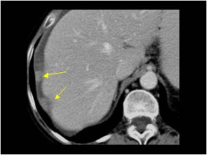 Peritoneal metastasis around the liver CT