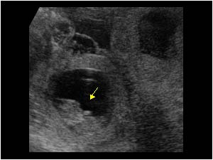 Small embryo in an ectopic gestational sac