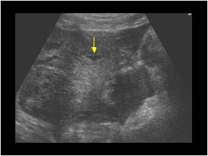 Fluid filled uterine cavity and hematoma transverse