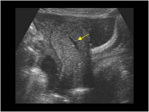Fluid filled uterine cavity and hematoma longitudinal