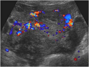 Irregular hematoma in the lower abdomen around the uterus transverse