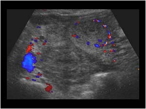 Irregular hematoma in the lower abdomen around the uterus longitudinal