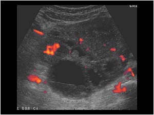 Hypervascularized mass around the uterus