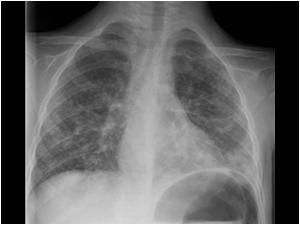 X ray of the thorax PA with diffuse pulmonary abnormalities