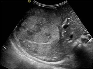 Ultrasound image of the liver with a large mass