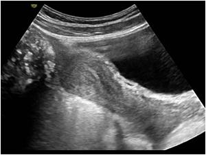 Longitudinal image of the normal uterus. Part of the calcified mass is seen cranial to the uterus