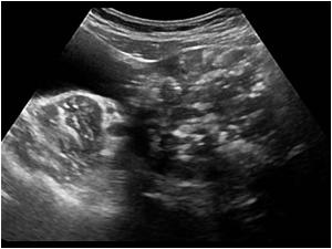 Image of the mass in the left lower abdomen