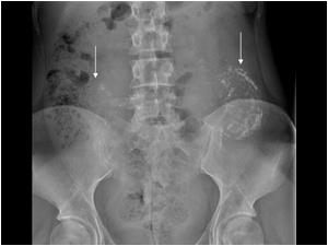 Plain abdominal X ray of the abdomen showing the calcifications
