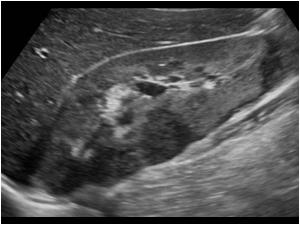 Longitudinal image of the right kidney with hypoechoic mass lesions