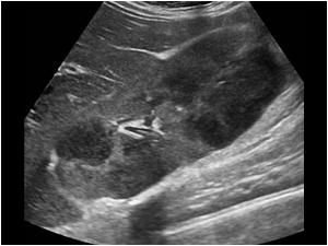 Another longitudinal image of the right kidney