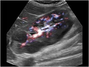 Another longitudinal color doppler image of the right kidney
