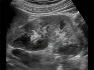 Longitudinal image of the left kidney with similar hypoechoic lesions