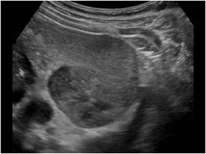 Transverse image of the left kidney with hypoechoic lesions