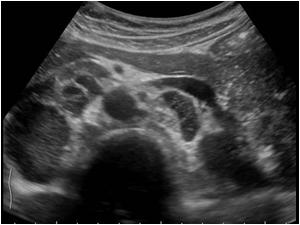 Transverse image of the enlarged retroperitoneal lymph nodes