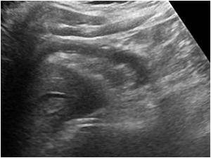 Abnormal tubular structure anterior of the right liver lobe