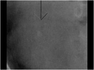 X ray of the ureteric stone