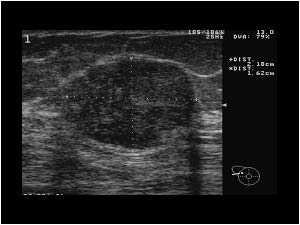Fibroadenoma 1 in the right breast