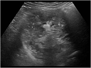 Transverse image of the right kidney