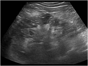Longitudinal image of the left kidney