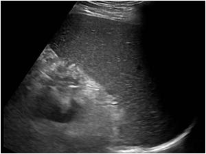 Transverse image of the enlarged spleen