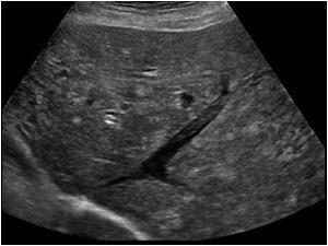 Another image of a thrombus in a liver vein (Budd Chiari)